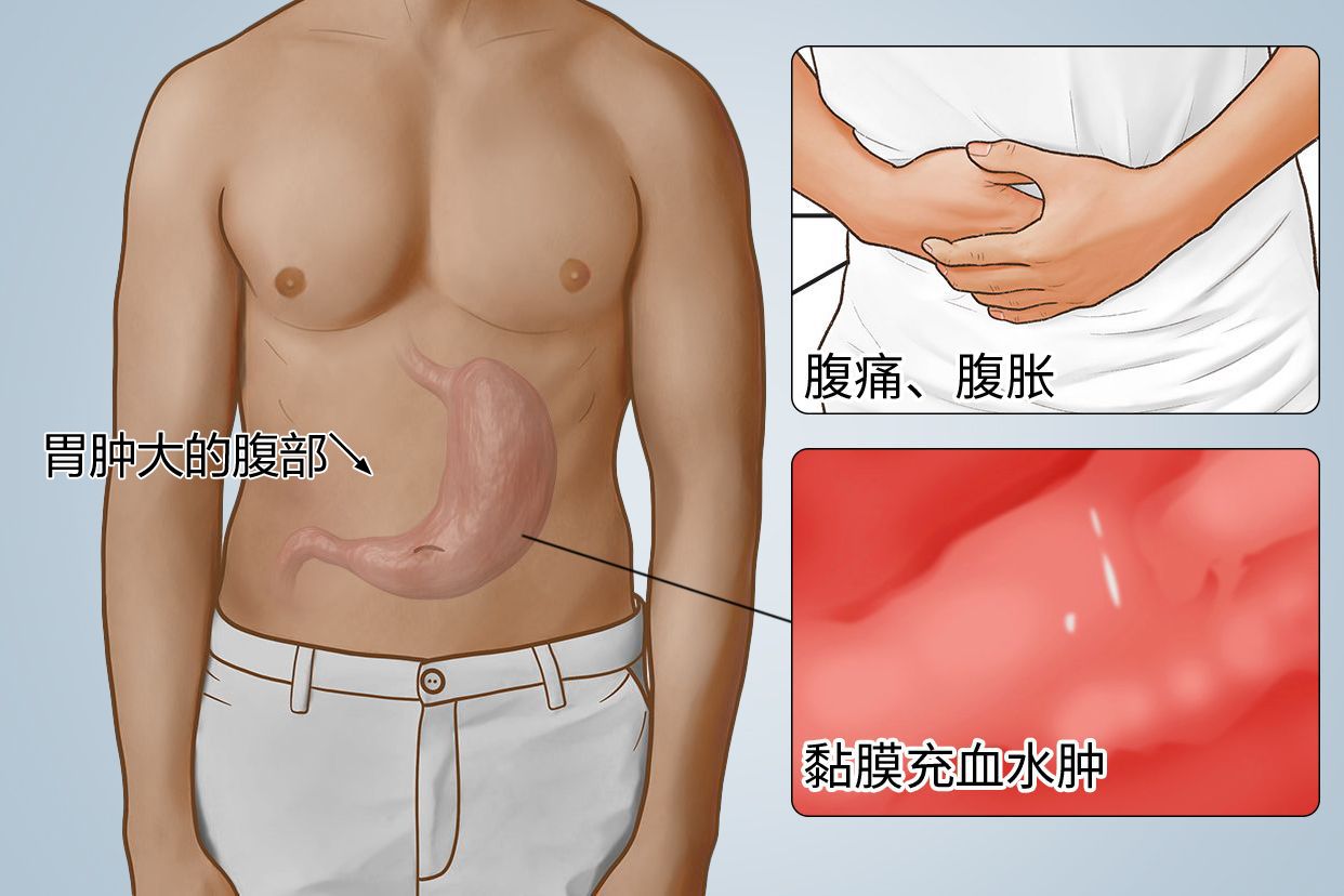胃肿大的腹部图片