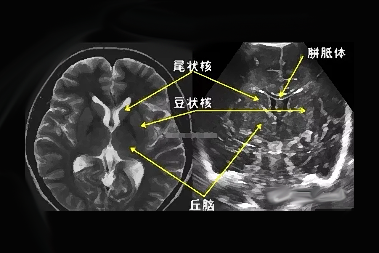 胎儿颅内结构正常超声图谱